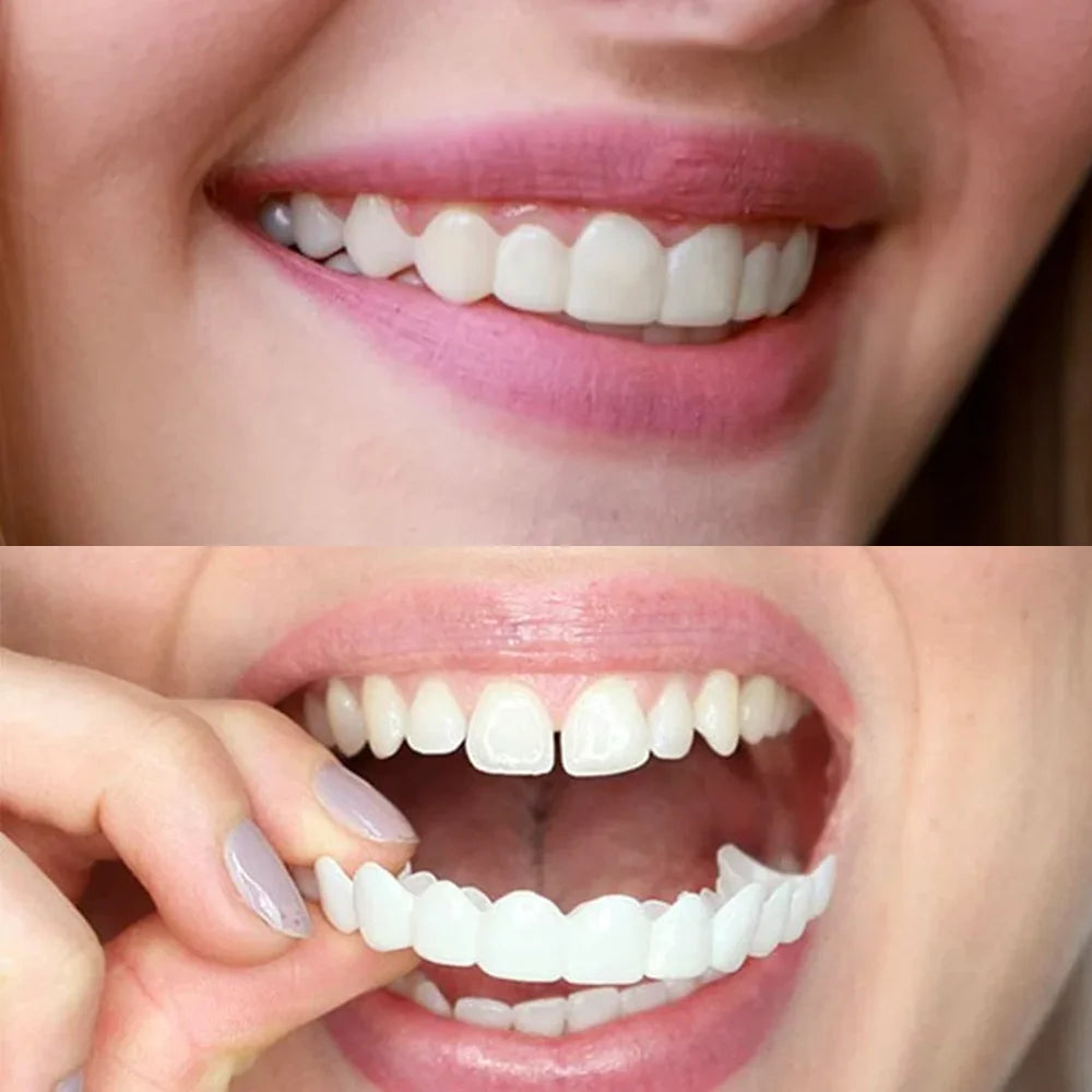 Snap on Smile Veneers (Upper & Lower)